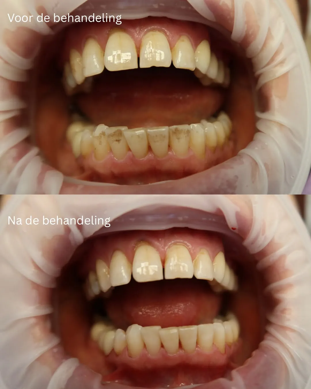 Het gebit voor en na een professionele gebitsreiniging bij de mondhygiënist